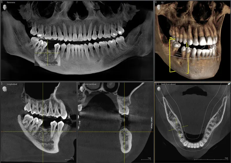 3D X-ray (cone beam CT) of the jaw